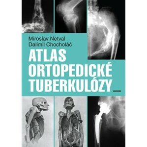 Atlas ortopedické tuberkulózy - Miroslav Netval, Dalimil Chocholáč