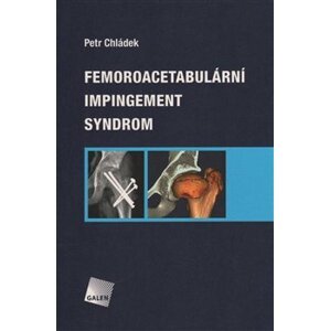 Femoroacetabulární impingement syndrom - Petr Chládek