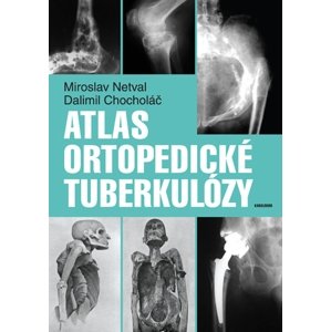 Atlas ortopedické tuberkulózy -  Dalimil Chocholáč